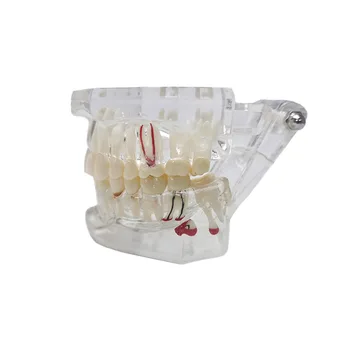 Стоматологическая Прозрачная модель зубов, демонстрирующая Посадку ногтей, модель учебной практики для общения с медицинскими пациентами